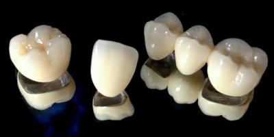 PFM crown and bridge