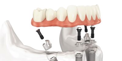 implant-1